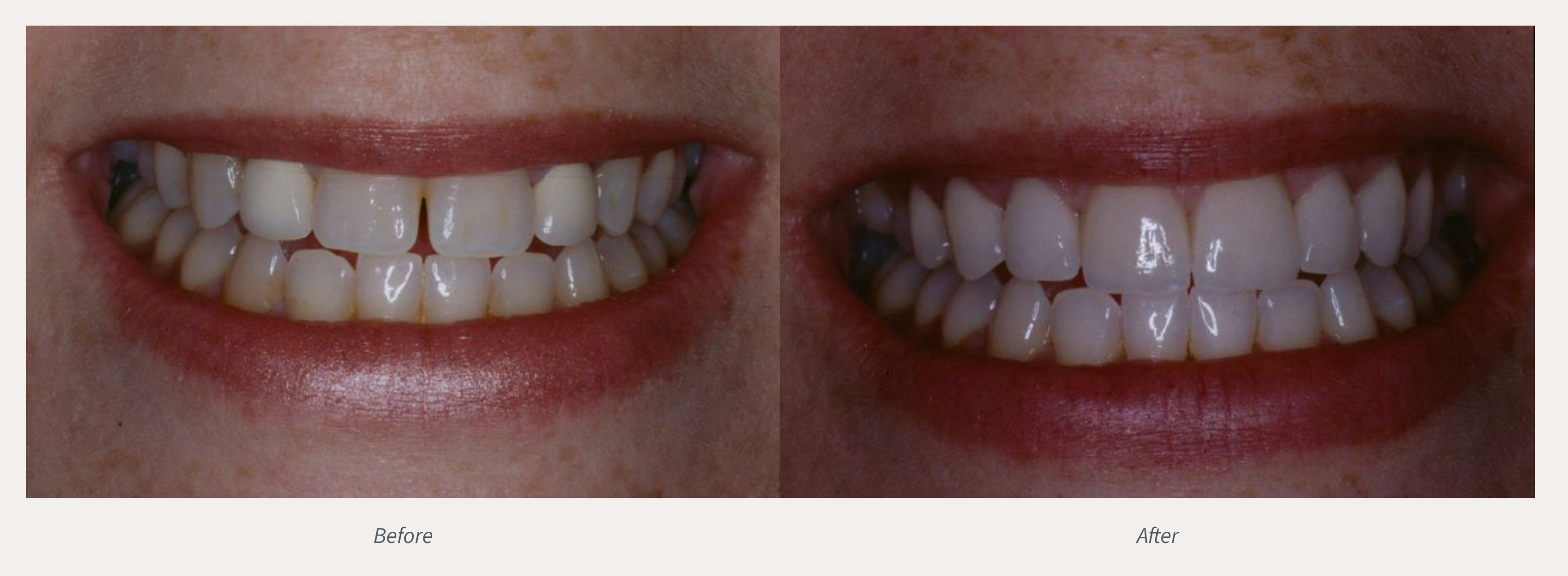 Teeth Whitening Before & After from Advanced Dental Care | Valdosta, GA