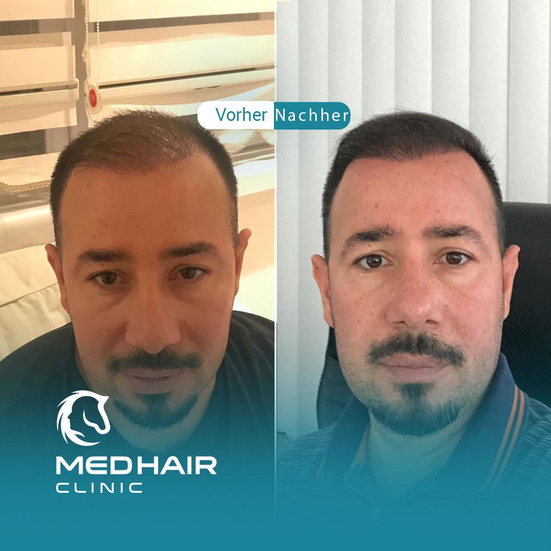 MedHair Clinic | Niederlassung Berlin | Haartransplantation Türkei, Silvio Meier Strasse 2 in Berlin