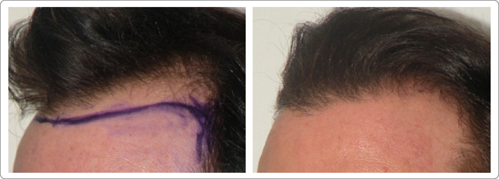 Images Hair Transplant Center NYC