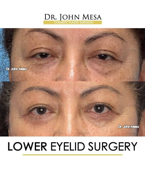 Images Dr. John Mesa, MD: Plastic Surgeon NYC, Buccal Fat Removal, Chin Liposuction, Facelift, Facial Masculinization, Chin Implant