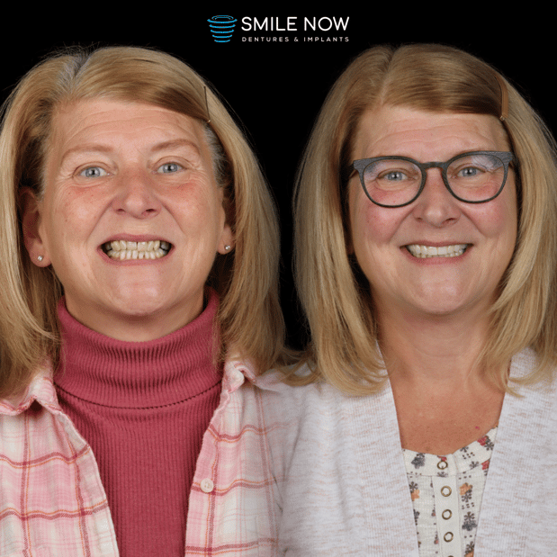 Images Smile Now Milwaukee Dentures and Implants