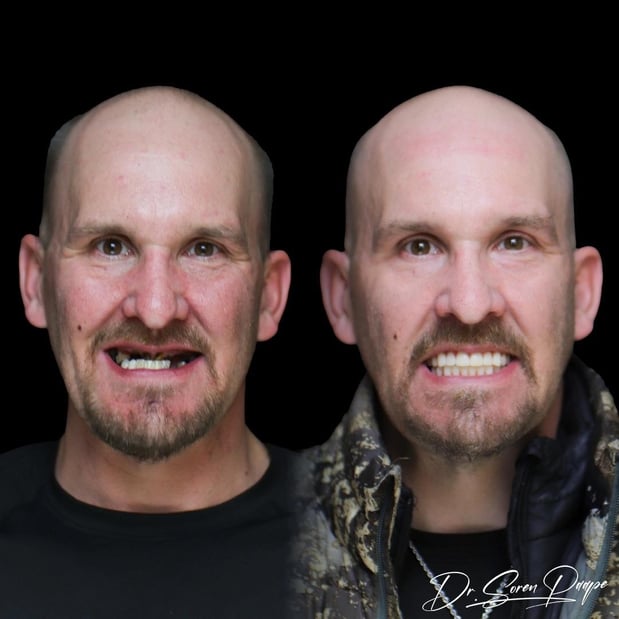 Images Smile Now Denver Dentures and Implants
