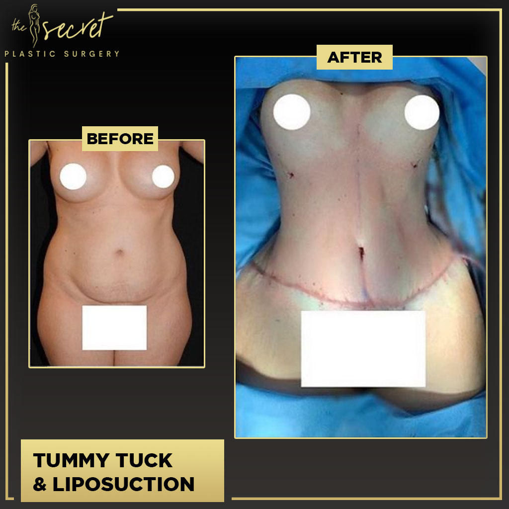 Liposuction - The Secret Plastic Surgery