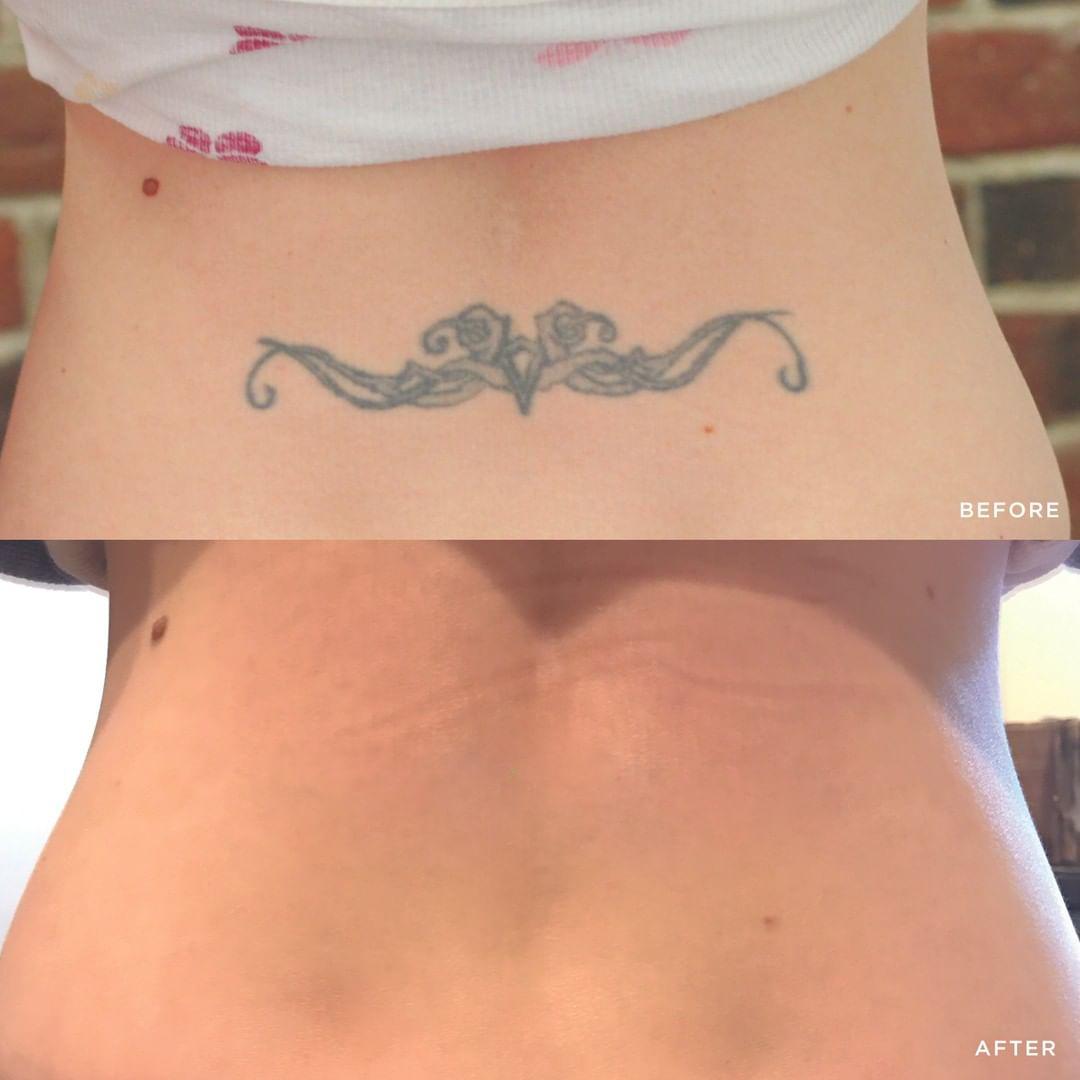 Removery Tattoo Removal & Fading à Ottawa: Before & After Lower Back Tattoo Removal