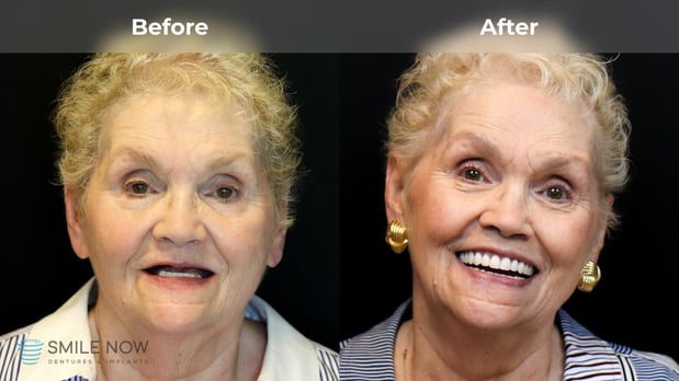 Images Smile Now Milwaukee Dentures and Implants