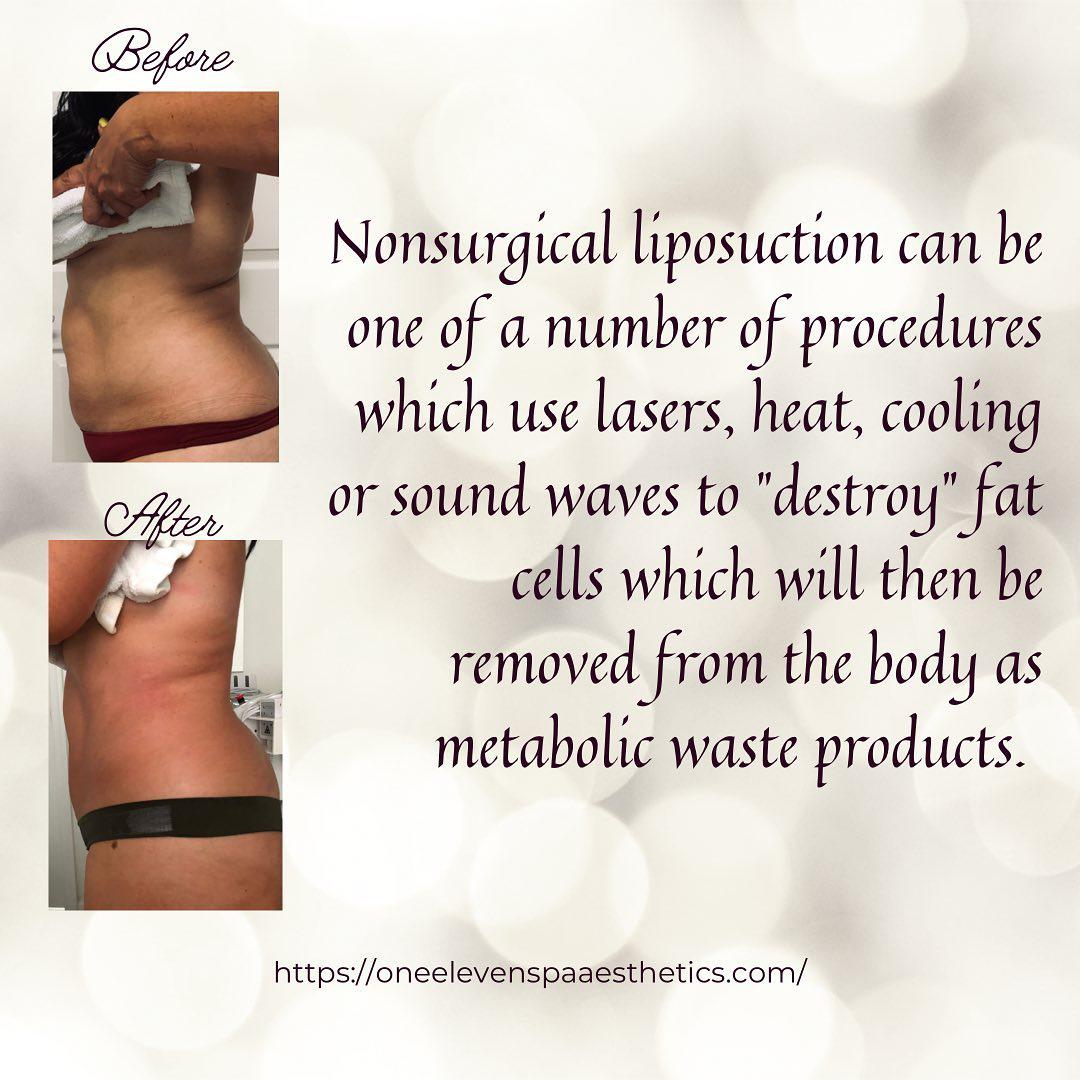 Nonsurgical liposuction can one of a number of procedures which use lasers. heat, Cooling or sound waves to "destroy" Fat cells which will then be removed from the body as metabolic waste products