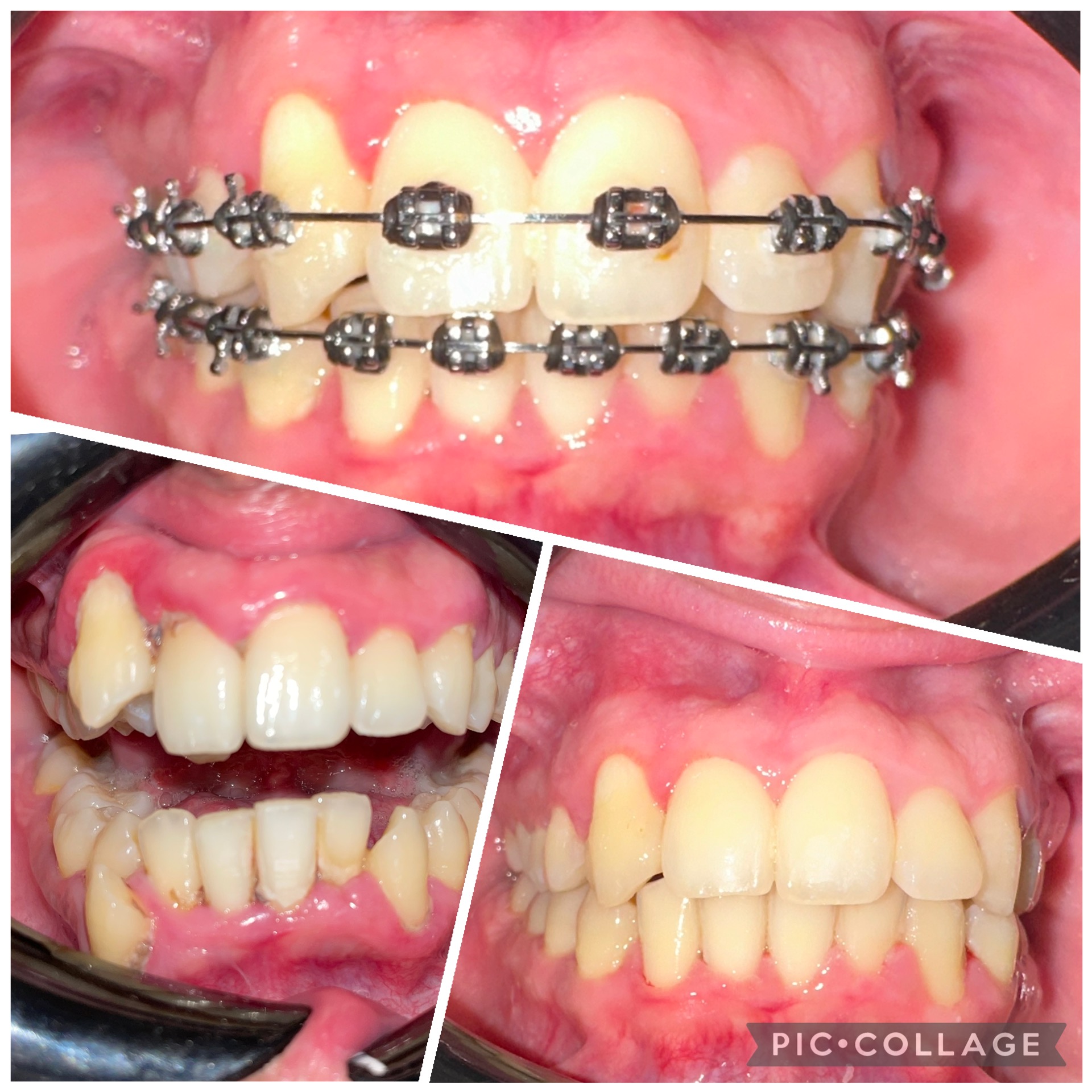 Cortes Family Dentistry- Brackets tradicionales