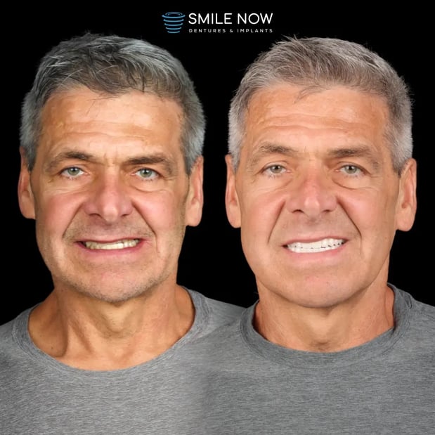 Images Smile Now Tacoma Dentures and Implants