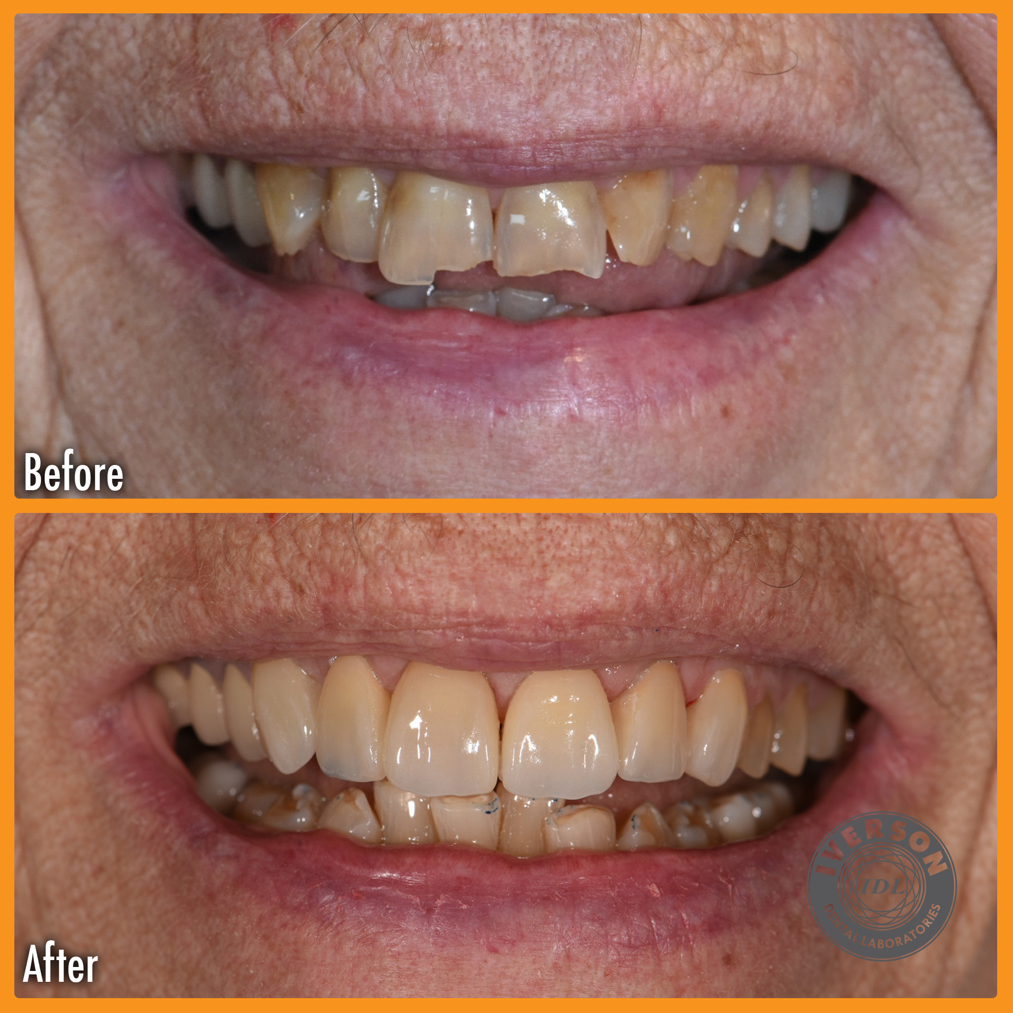 A patient with a dull and uneven smile before the restoration, transformed into a bright, symmetrical smile showcasing natural-looking teeth after the treatment by Iverson Dental Labs.