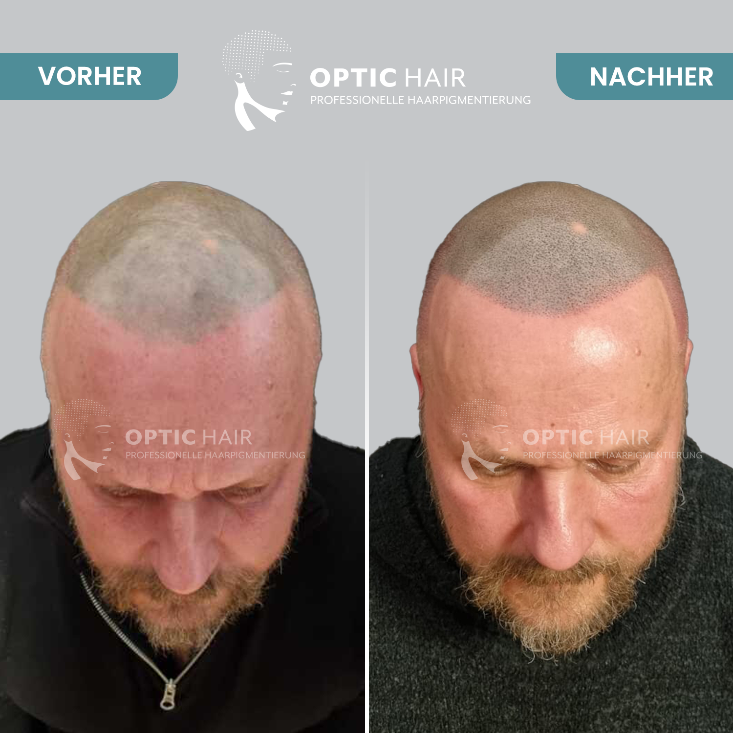 Kundenfoto 21 Haarpigmentierung Köln | OpticHair