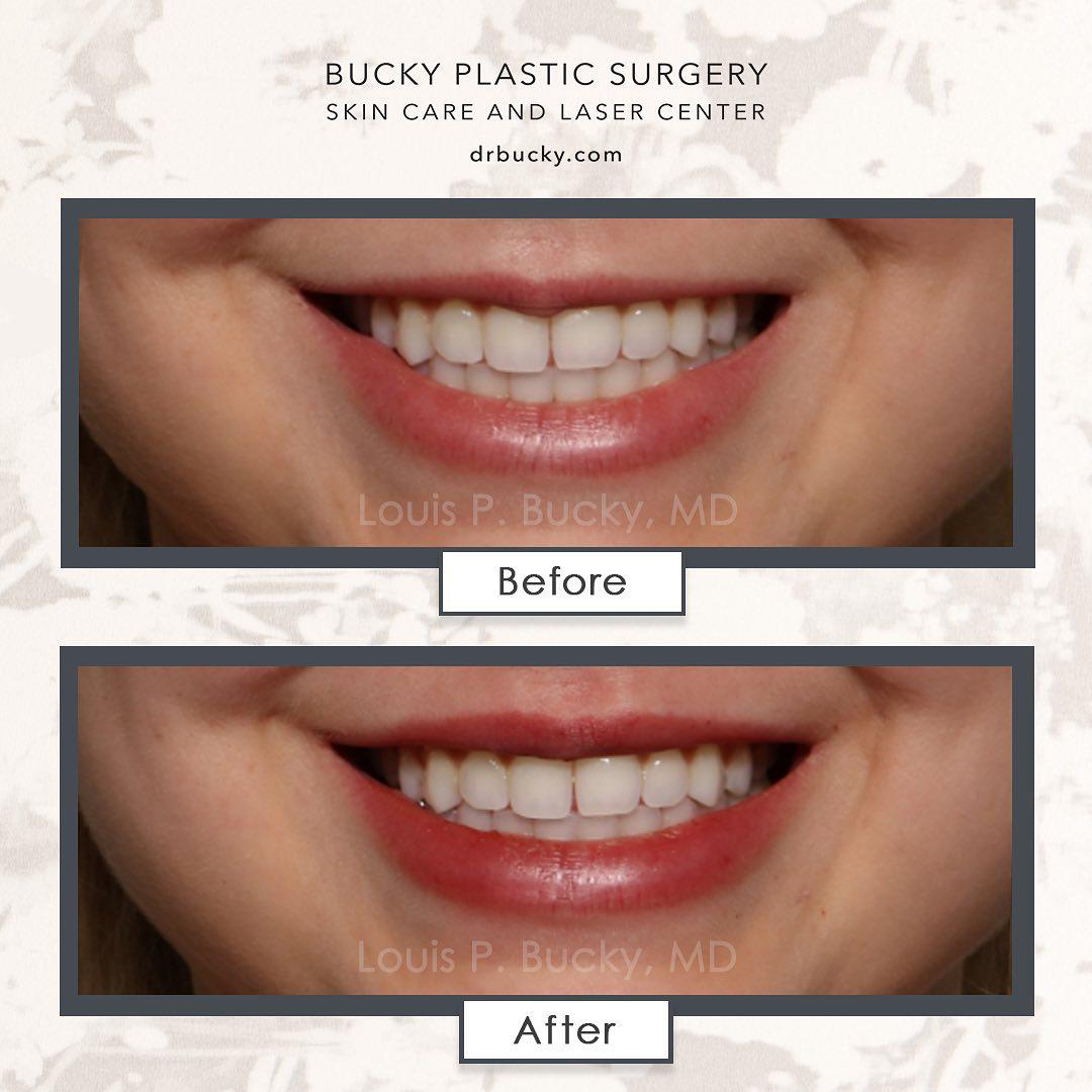 Patient before and after photos using Juvederm Ultra Plus with patient smiling. Louis P. Bucky, MD, FACS Philadelphia (215)829-6320