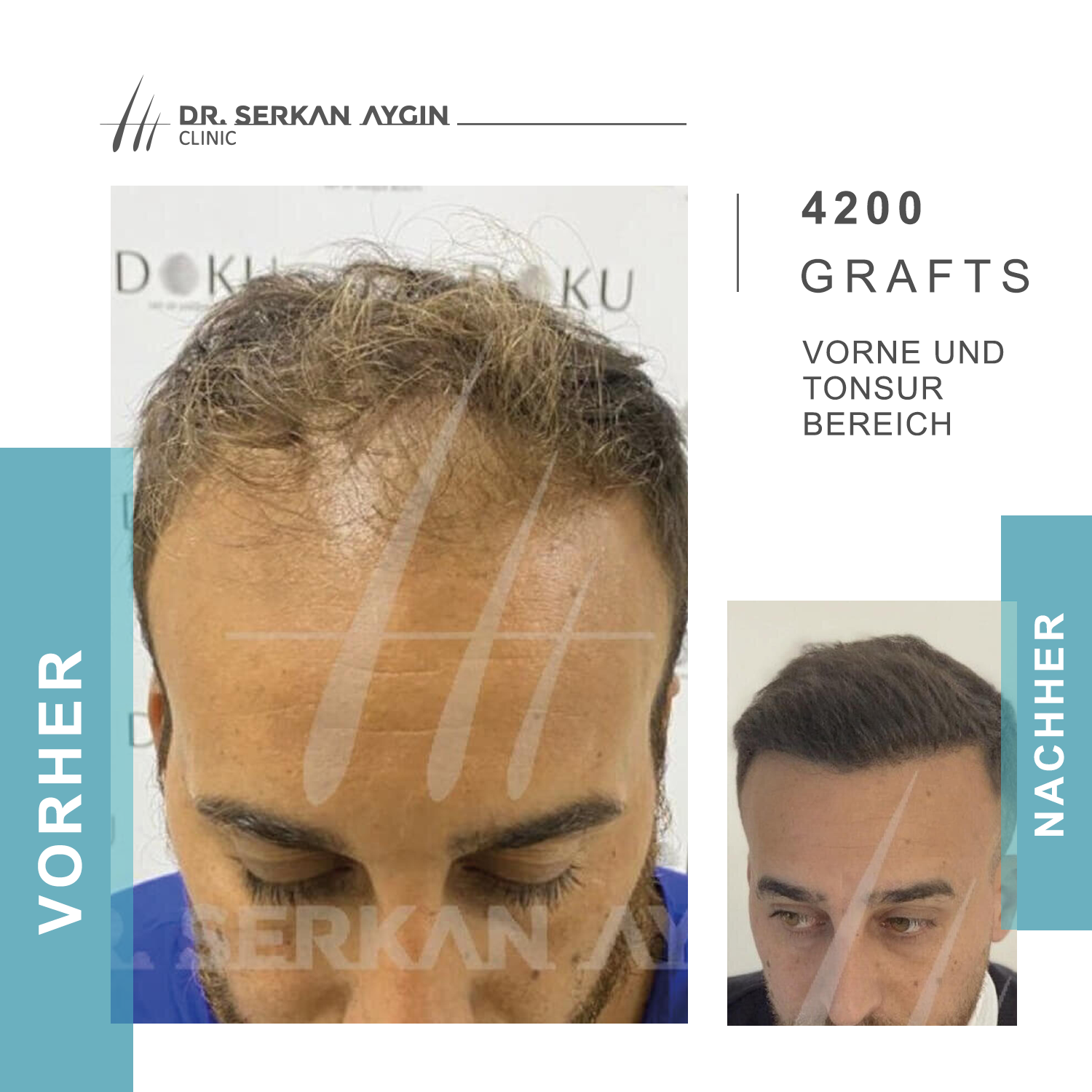 Bilder Dr Serkan Aygin | Niederlassung Köln | Haartransplantation Türkei