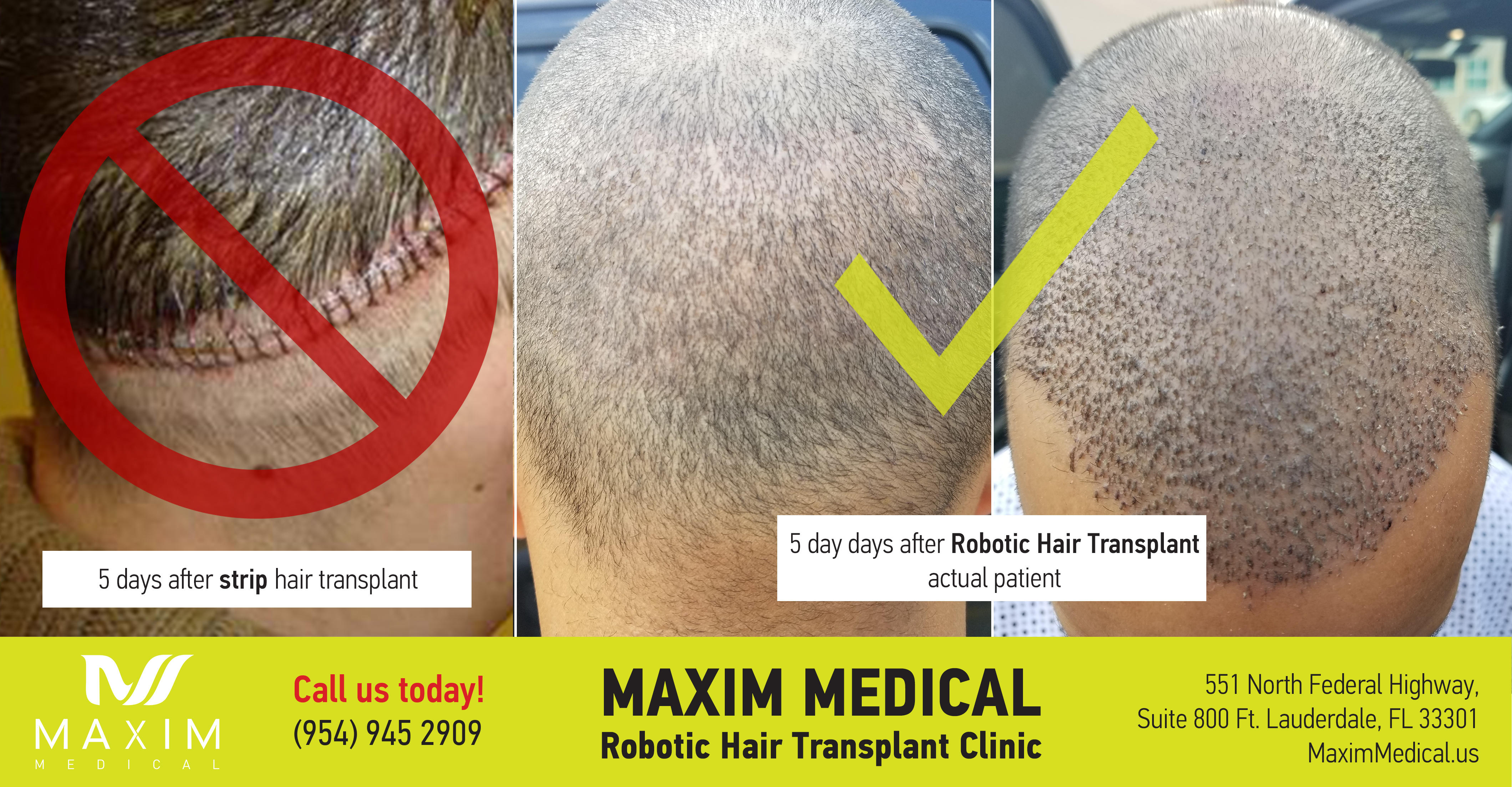 Maxim Medical hair transplant patient from 5 days ago. No scar, almost undetectable implant harvesting area. 2100 grafts transplanted using ARTAS® Robotic. Grafts can be selected automatically to have 3 or more hairs each. Patient got back to work on the next day.