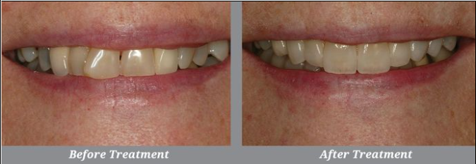 Veneers Before & After, Joseph P. Fusco DDS, MAGD | Rockville Centre, NY