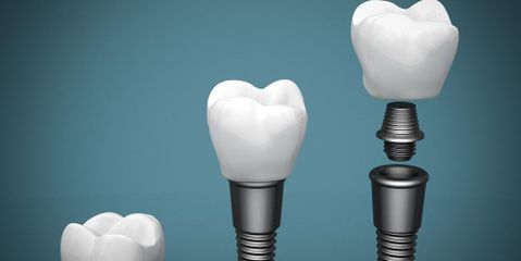 How Do Dental Implants Stay Put and Other Frequently Asked Questions