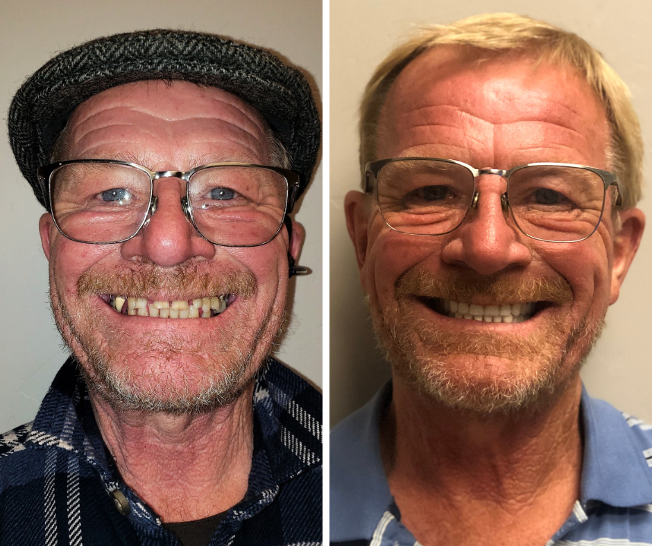 Before and After from Stubbs Dental | Layton, UT