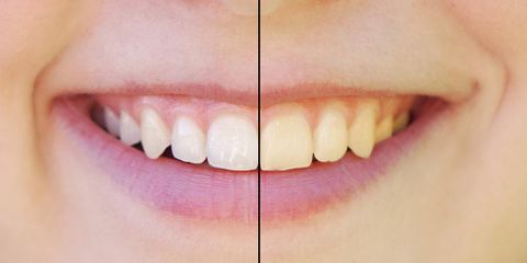3 Common Misconceptions about Teeth Whitening to Ignore