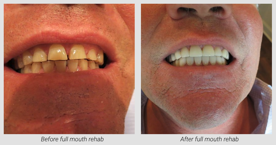 Full Mouth Rehabilitation Before & After at Lamendola Dentistry | Gonzales, LA