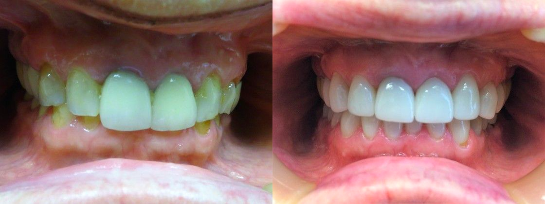 Before and After from Elite Dental Care | Eads, TN, , Dentist