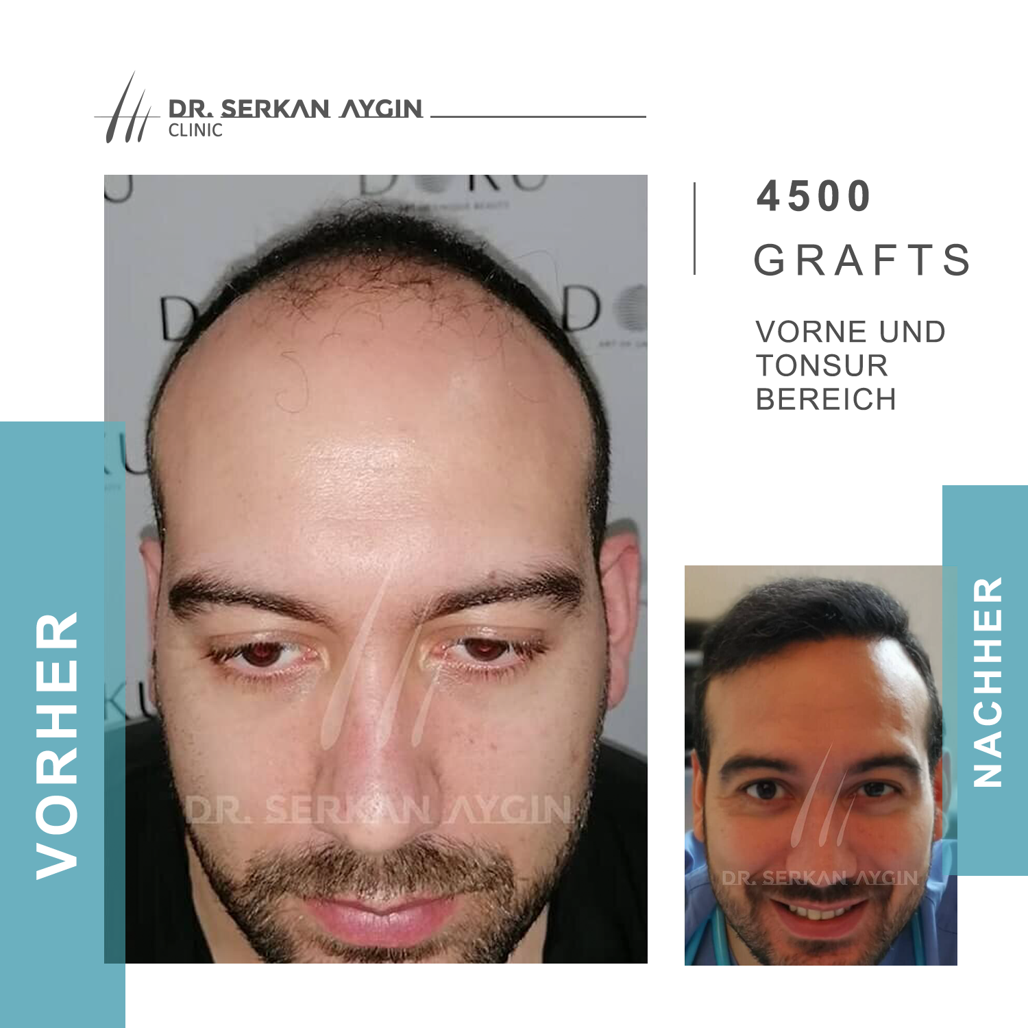 Kundenbild groß 16 Dr Serkan Aygin | Niederlassung Berlin | Haartransplantation Türkei
