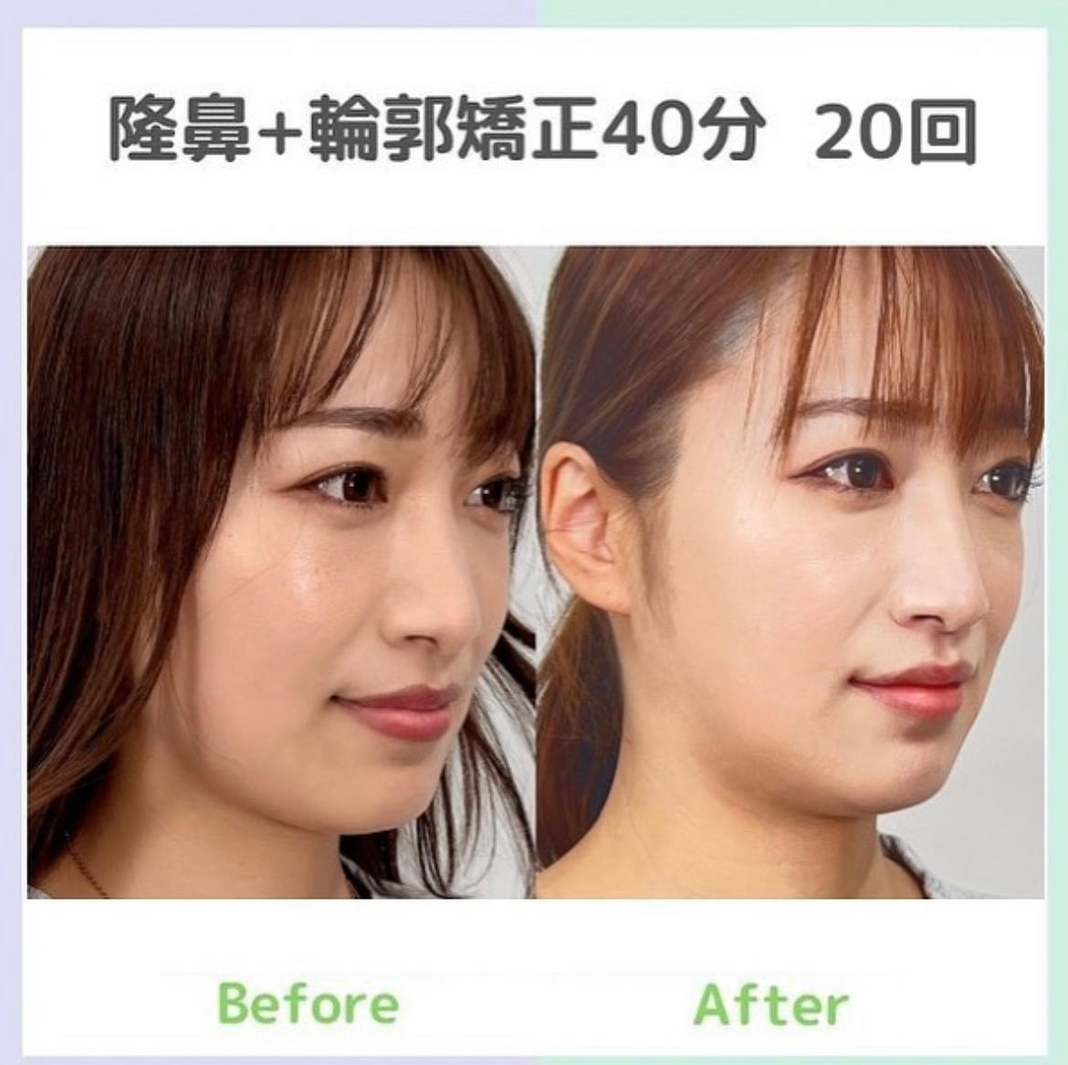 Images 隆鼻矯正専門店 Raplit 福岡博多店 (ラプリ)