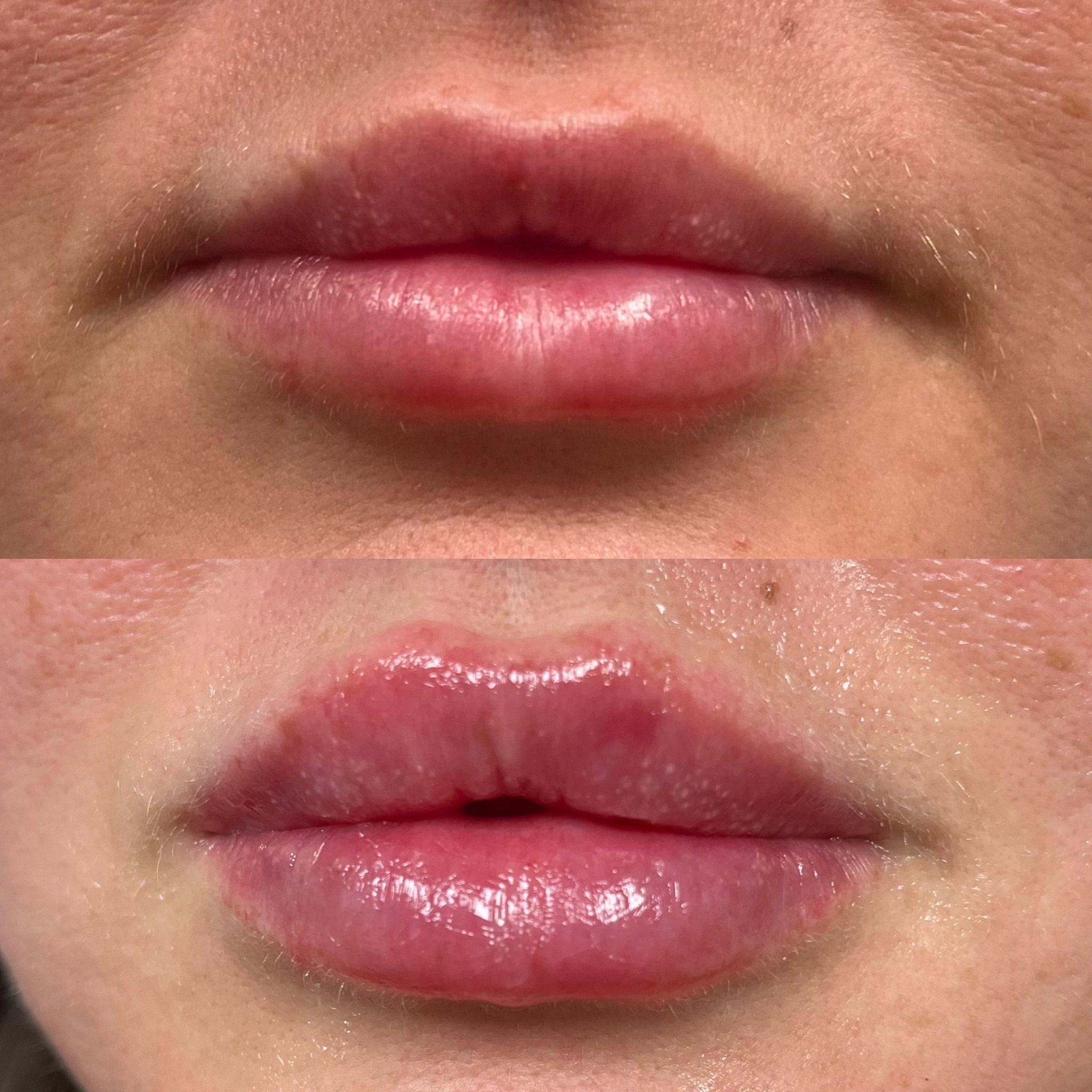 Lip filler before and after, Care Esthetics Delaware