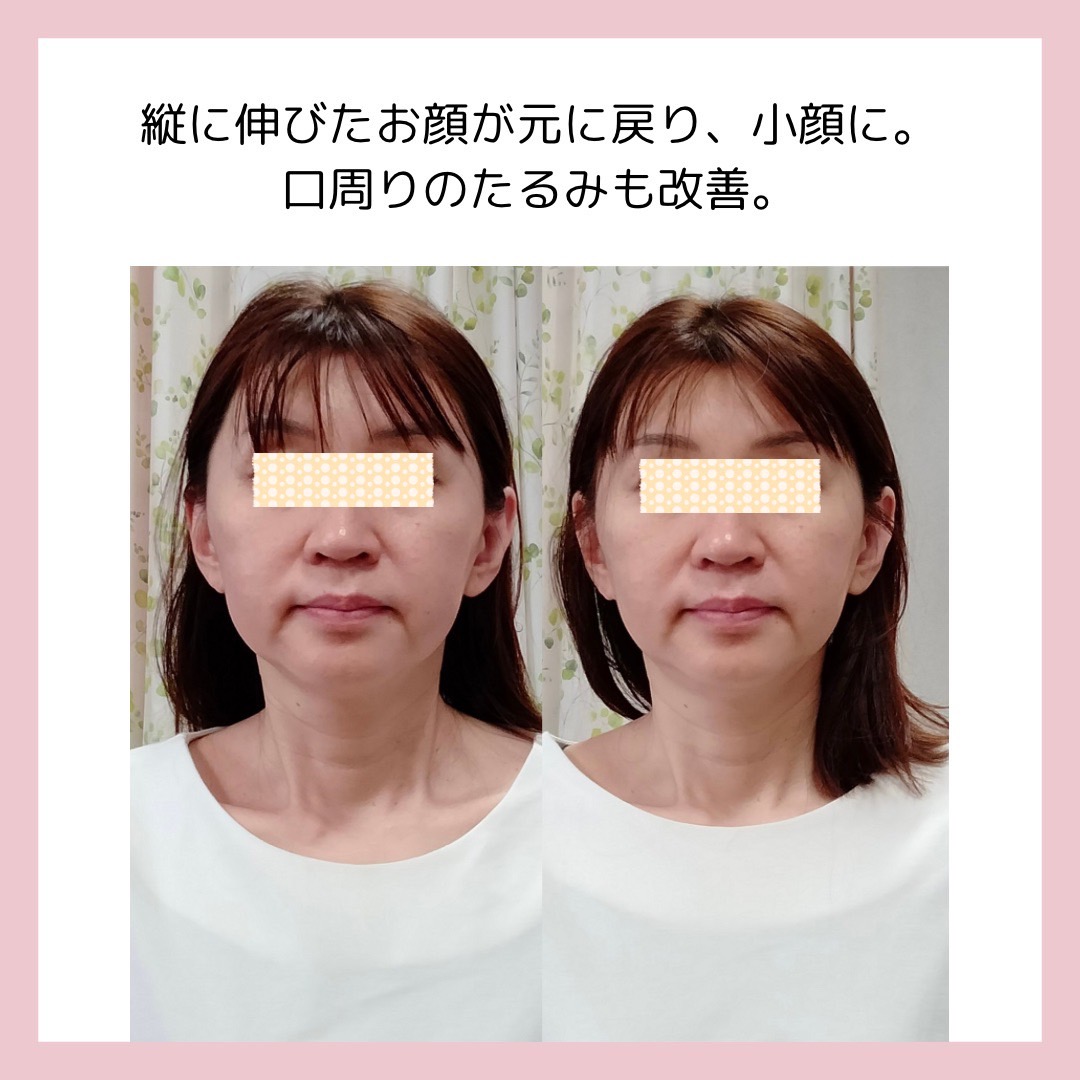 Images 目元・口元のたるみ&眉間シワ改善専門サロン