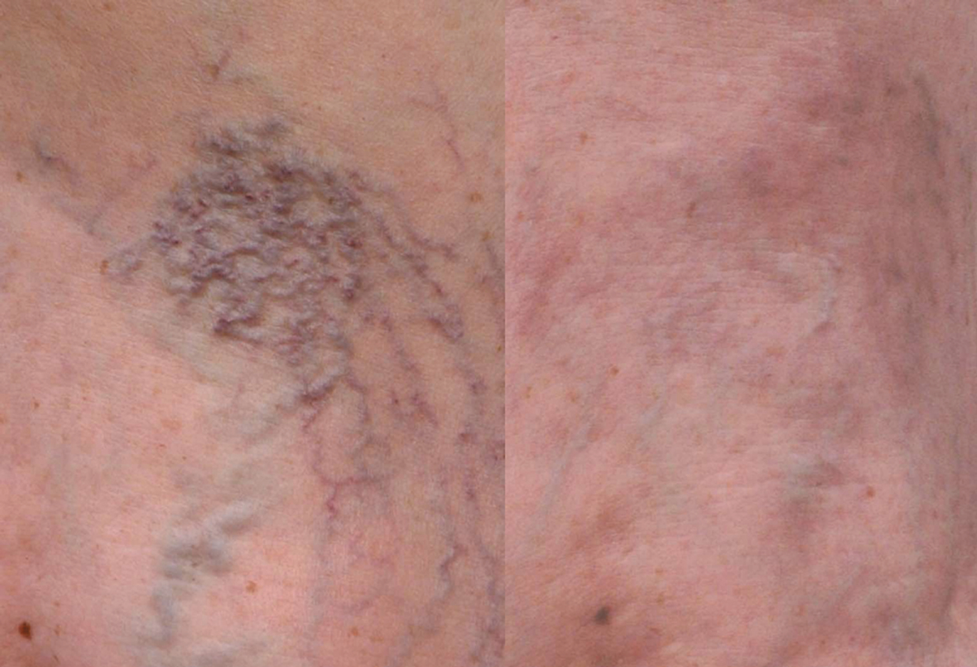 Spider Veins before and following treatment with sclerotherapy