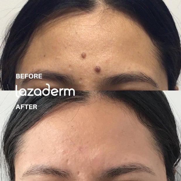 Images Lazaderm