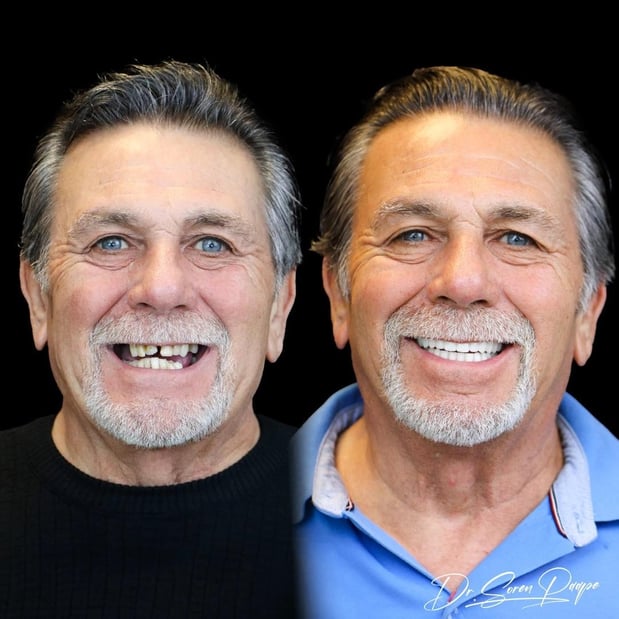 Images Smile Now Denver Dentures and Implants