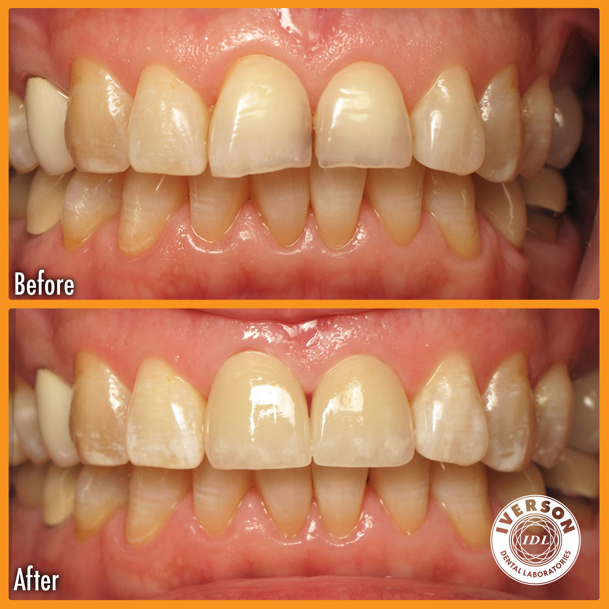 A patient showing severe wear and tear on their teeth in the "before" image, now beaming with a rejuvenated and youthful smile thanks to the expert work of Iverson Dental Labs.