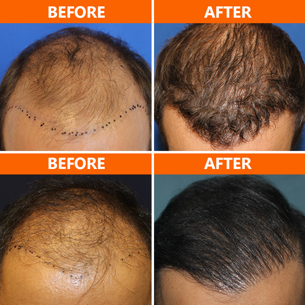 San Diego Hair MD offers the NeoGraft® hair transplant procedure, providing patients with natural-looking results! This minimally invasive hair restoration treatment extracts hair follicles from a donor area in the back of your head and implants them where thinning or balding has occurred.