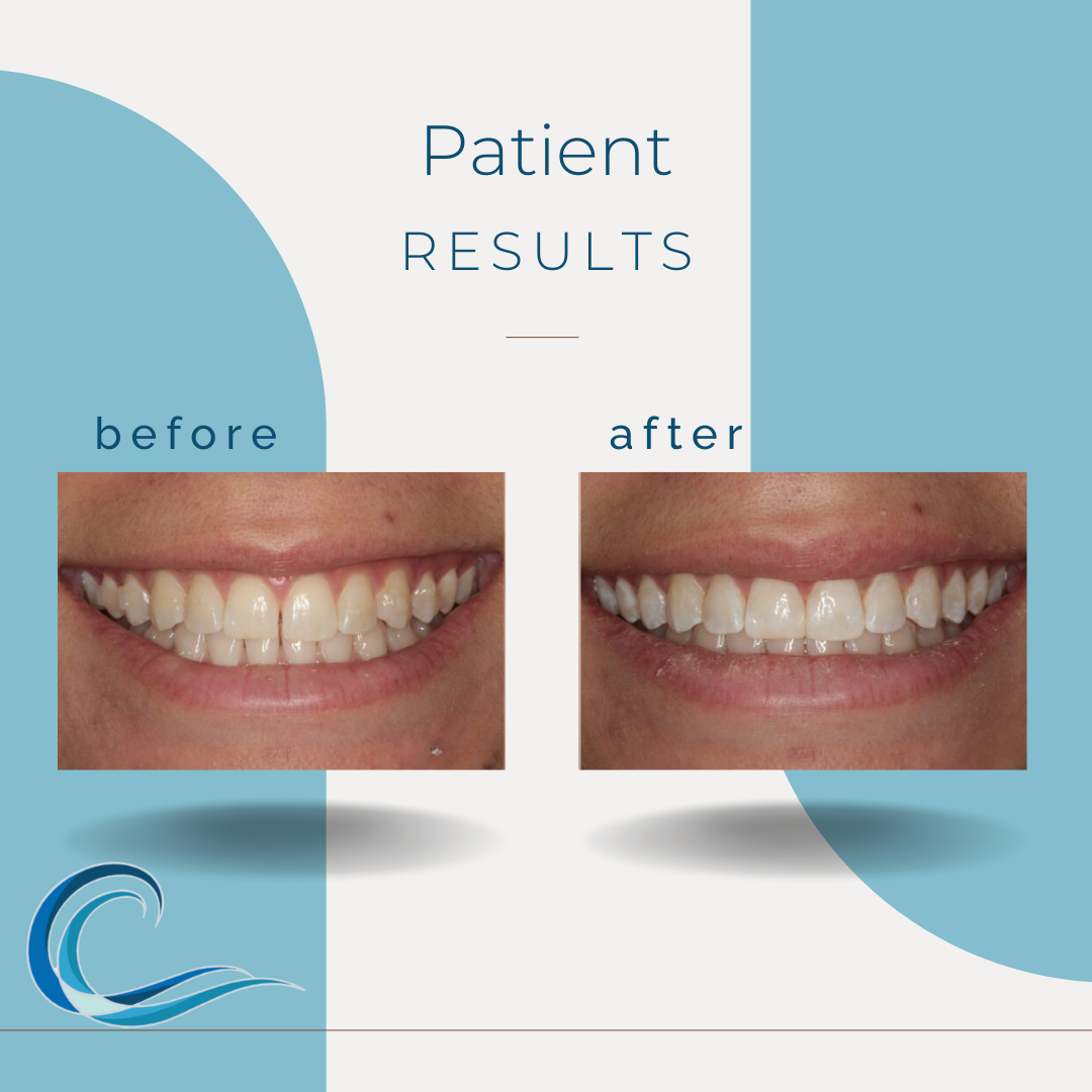 Before & After Results with Christopher Catalano, DDS | Kentfield, CA