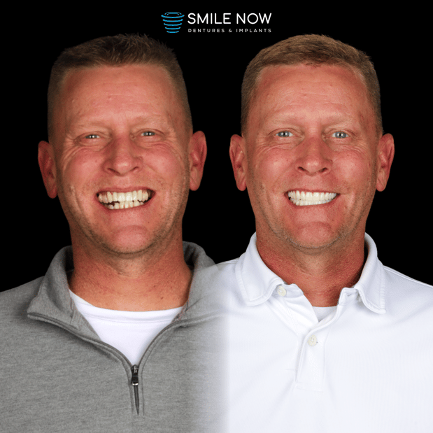 Images Smile Now Milwaukee Dentures and Implants