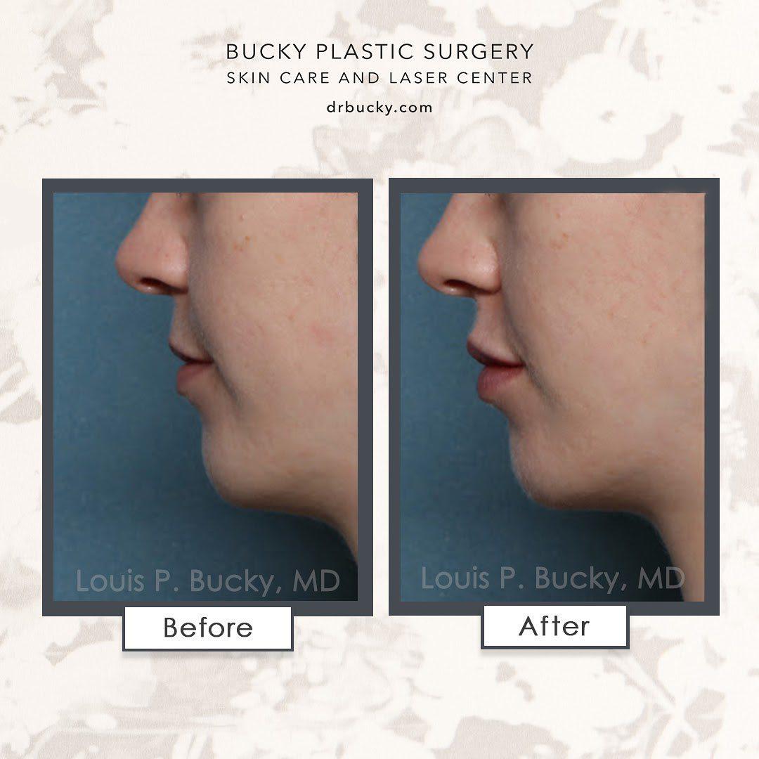 Patient before and after photos using 1ml of Juvederm Volbella in the upper and lower lips from the  Louis P. Bucky, MD, FACS Philadelphia (215)829-6320