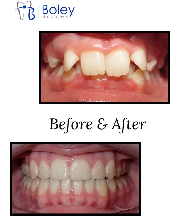 Images Boley Braces