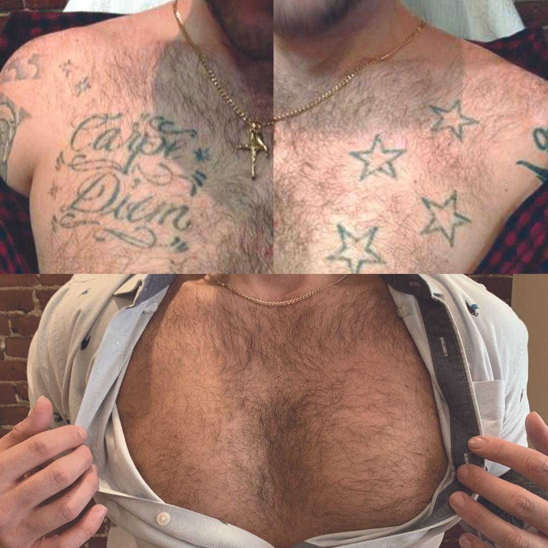 Removery Tattoo Removal & Fading à Ottawa: Before & After Chest Tattoo Removal