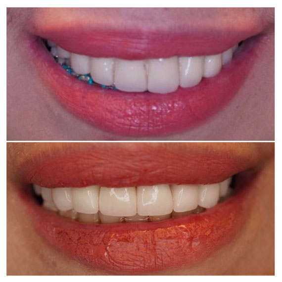 Cortes Family Dentistry- arreglo de sonrisa