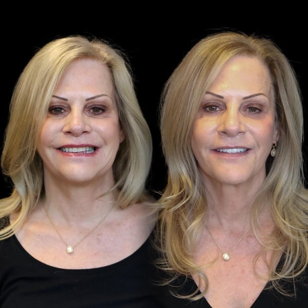 Images Smile Now Denver Dentures and Implants