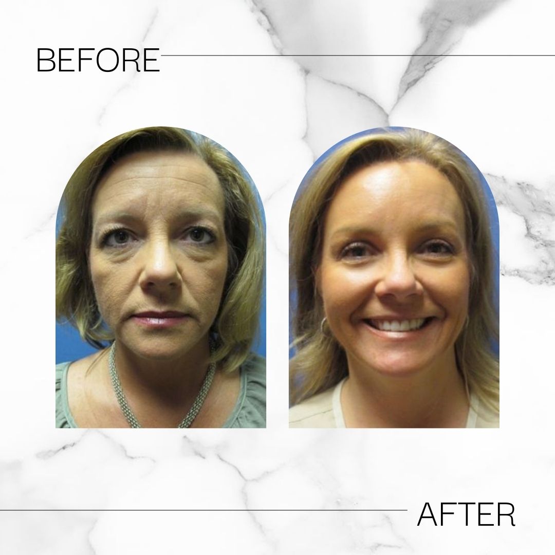 Before & After cosmetic filler results at Devlin Cosmetic Surgery: Michael Devlin, M.D. | Little Rock, AR