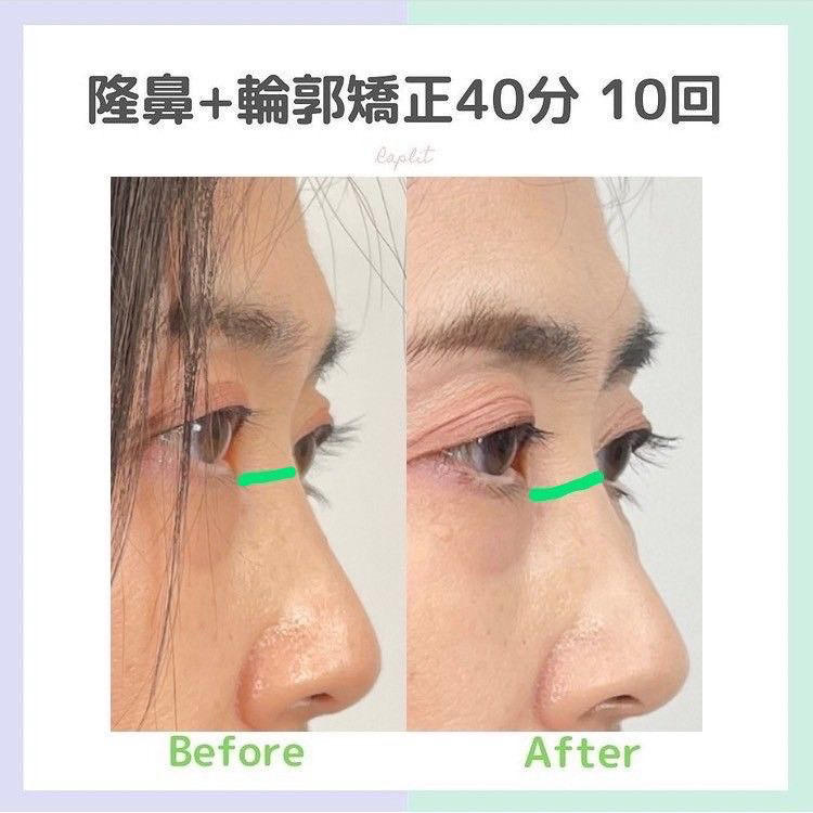 Images 隆鼻矯正専門店 Raplit 福岡博多店 (ラプリ)
