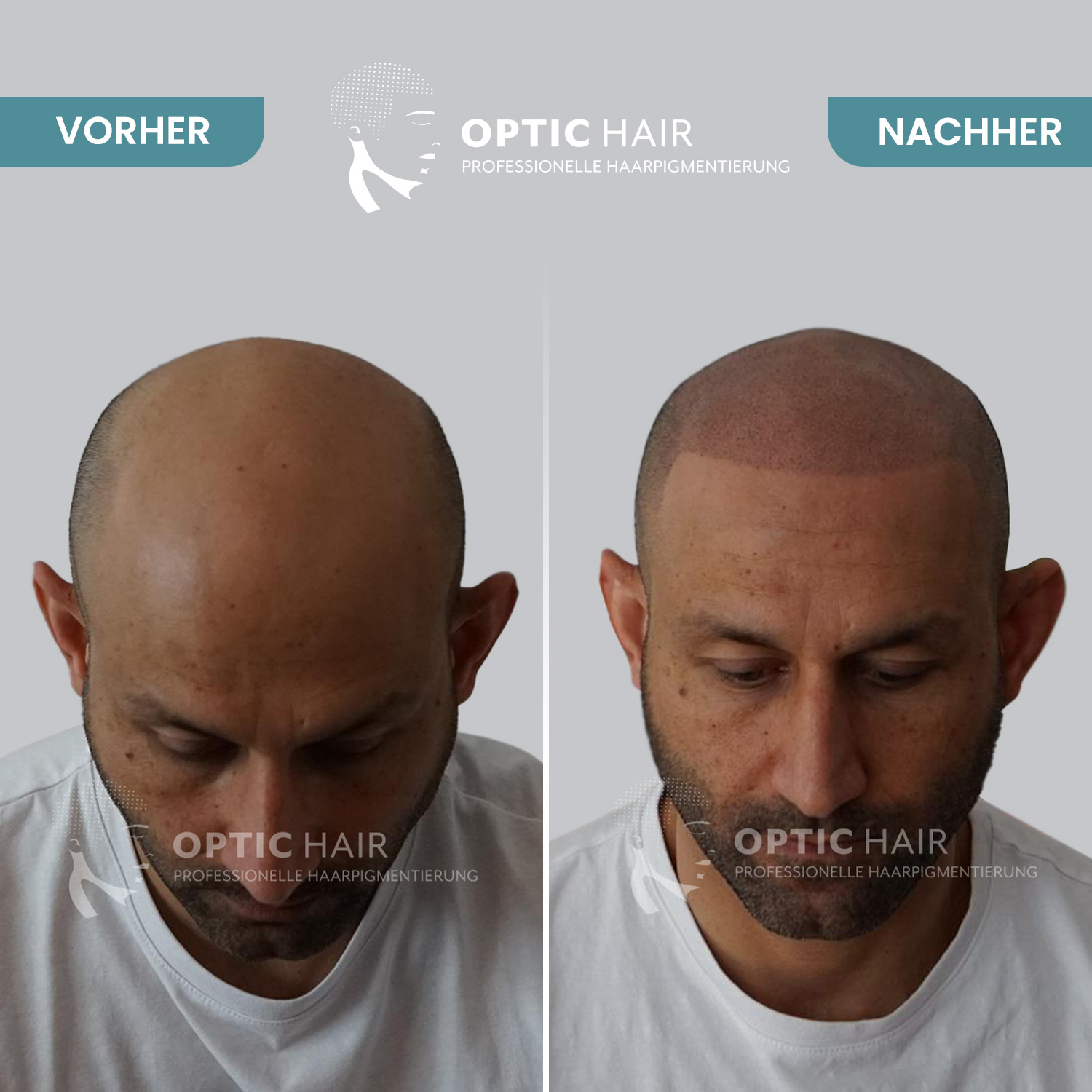 Kundenbild groß 12 Haarpigmentierung Köln | OpticHair