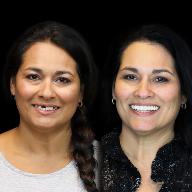 Images Smile Now Milwaukee Dentures and Implants
