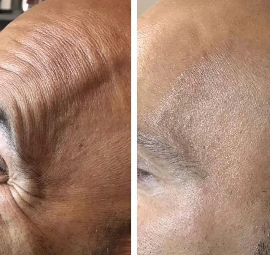 Botox Before & 3 Weeks After