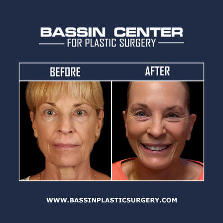 A facelift in Orlando with Dr. Bassin can treat various signs of facial aging, including wrinkles, creases, and folds. Additionally, a facelift can improve the appearance of jowls and loose skin for a more youthful-looking appearance. During facelift surgery, any incisions are discretely placed behind the ear for natural-looking results.