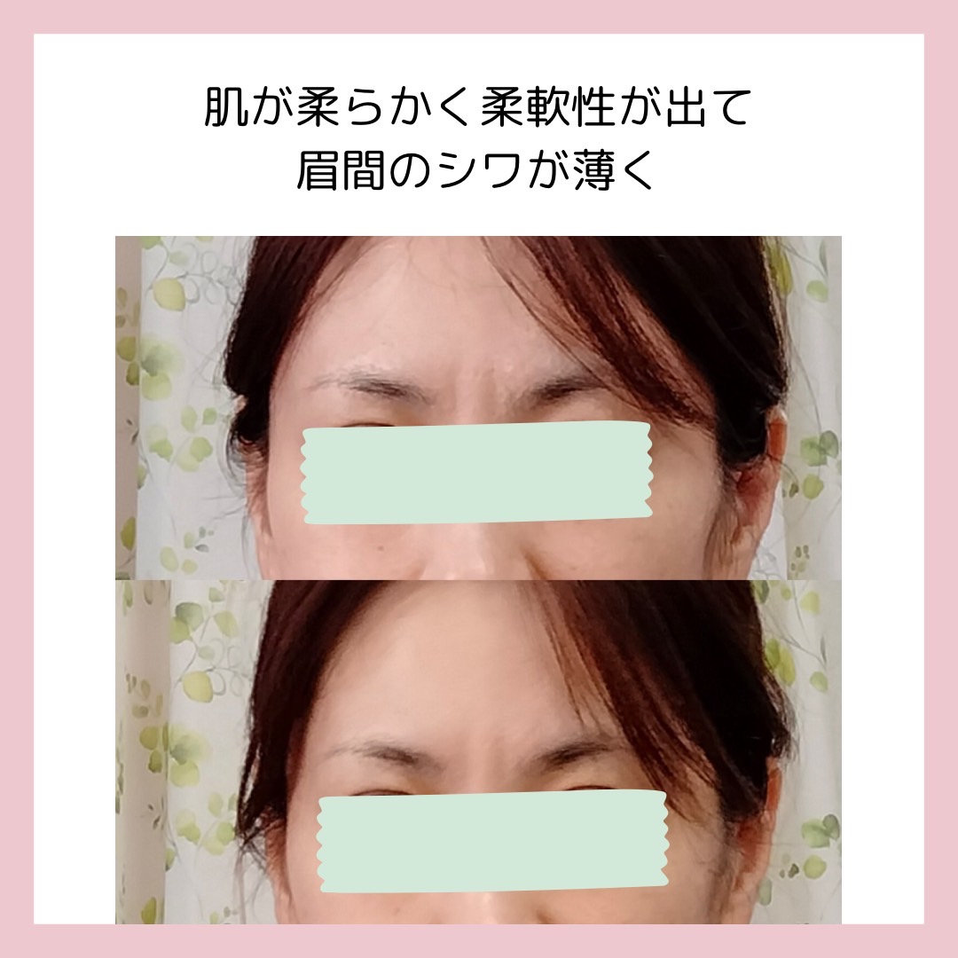 Images 目元・口元のたるみ&眉間シワ改善専門サロン