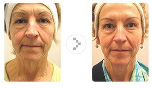 Skin Renewal