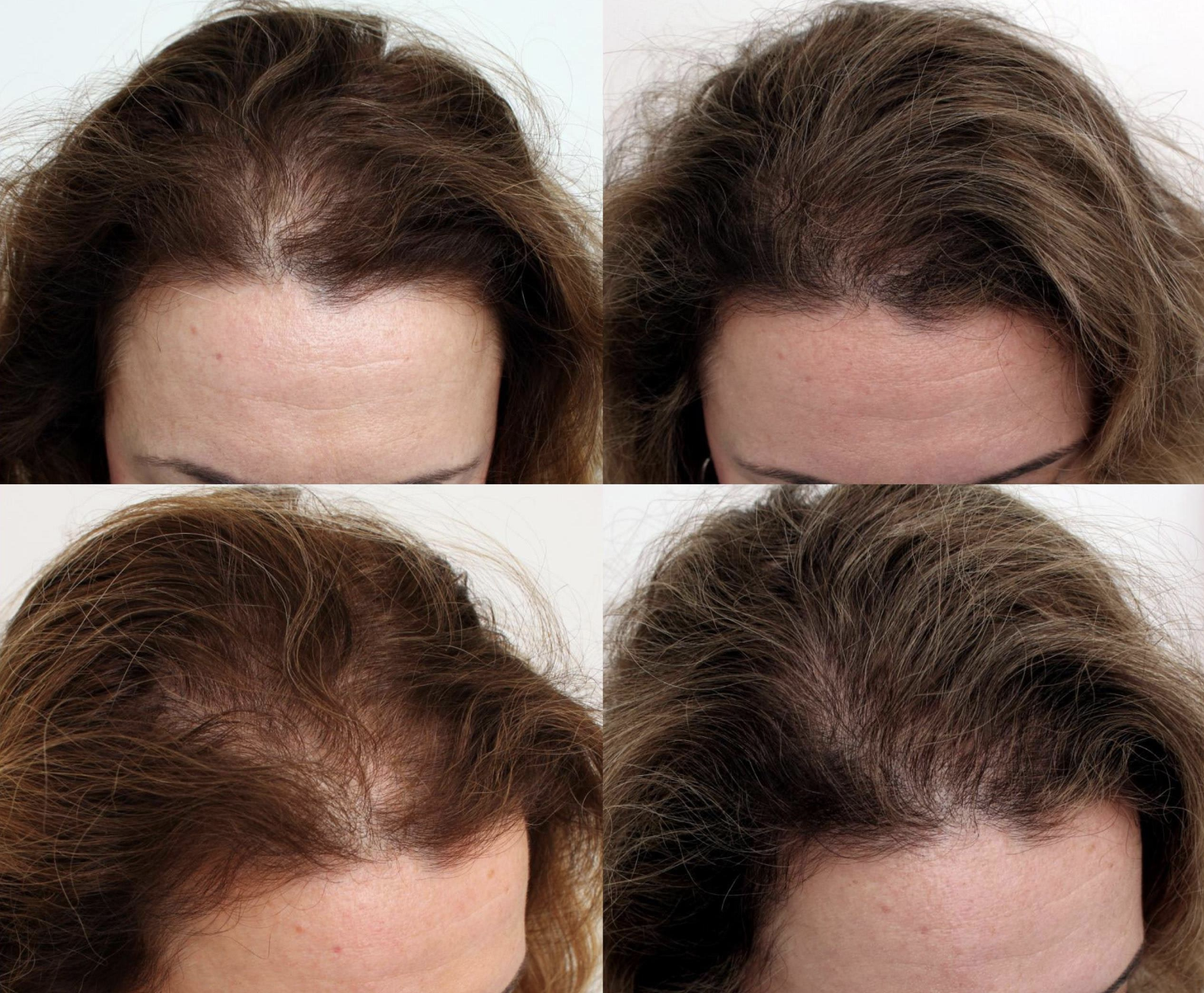 Results at The Hair Loss Doctors | New York,  NY