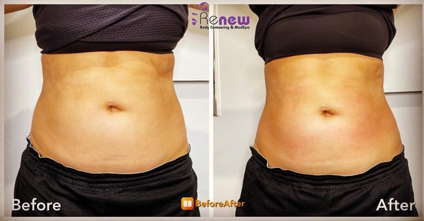Images Renew Body Contouring & MedSpa