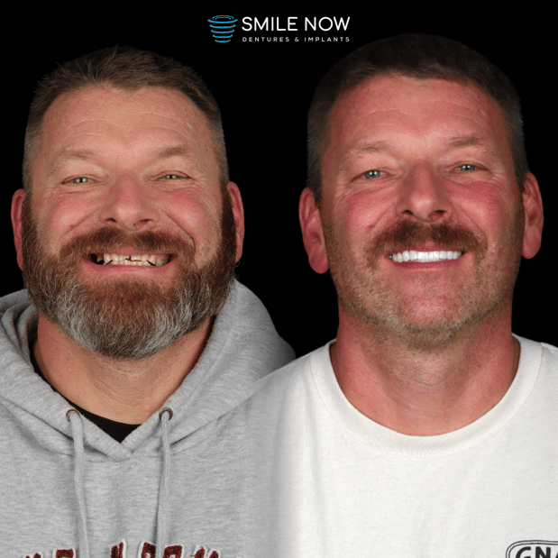 Images Smile Now Milwaukee Dentures and Implants